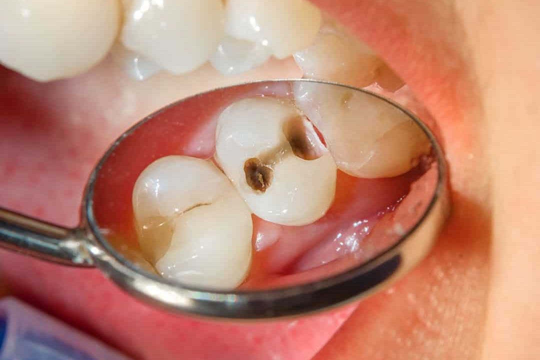 cavities and bad breath