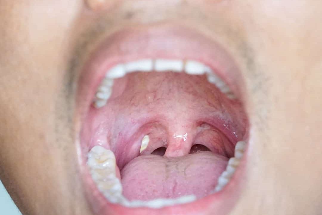 tonsil stones bad breath