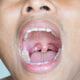tonsil stones bad breath